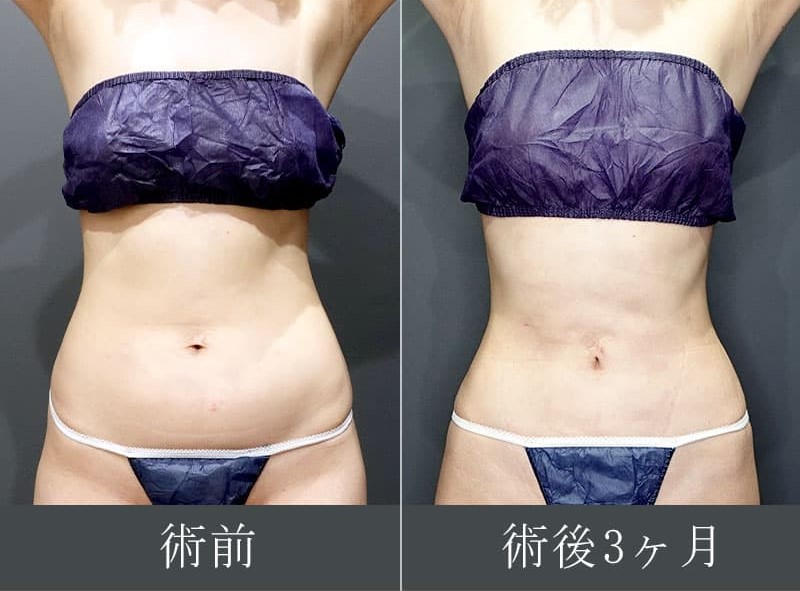 お腹の脂肪吸引症例写真①