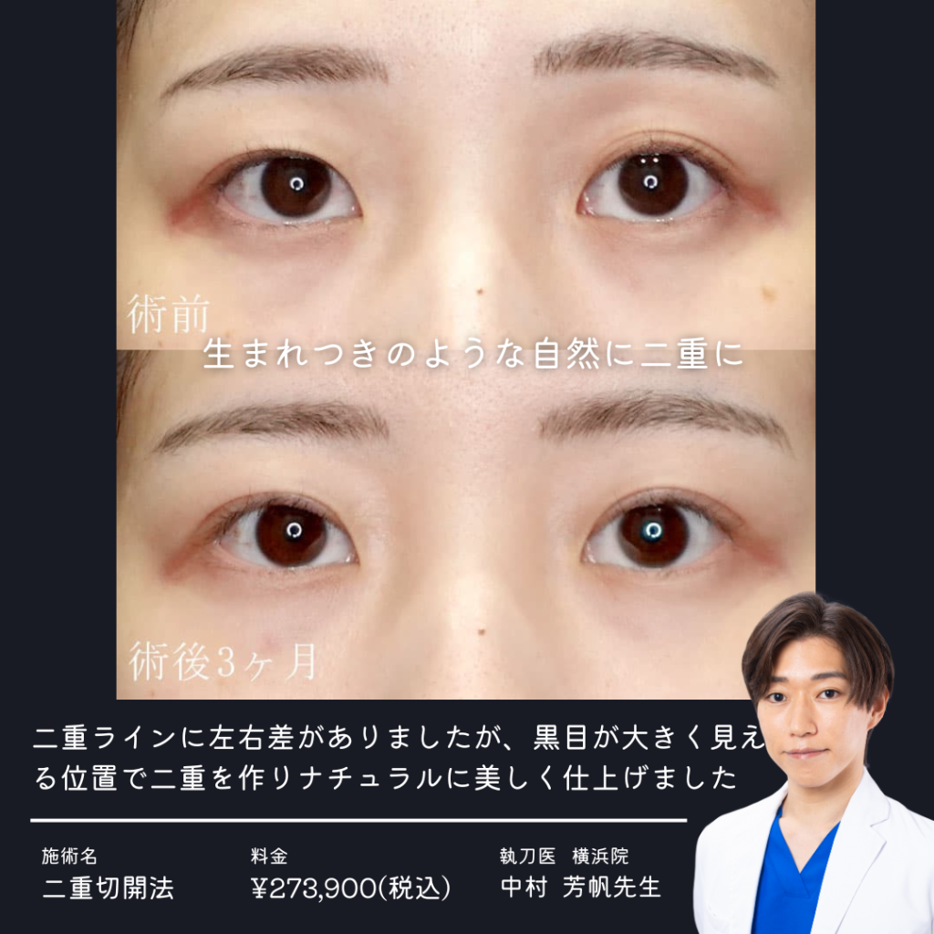 二重切開法の症例写真②