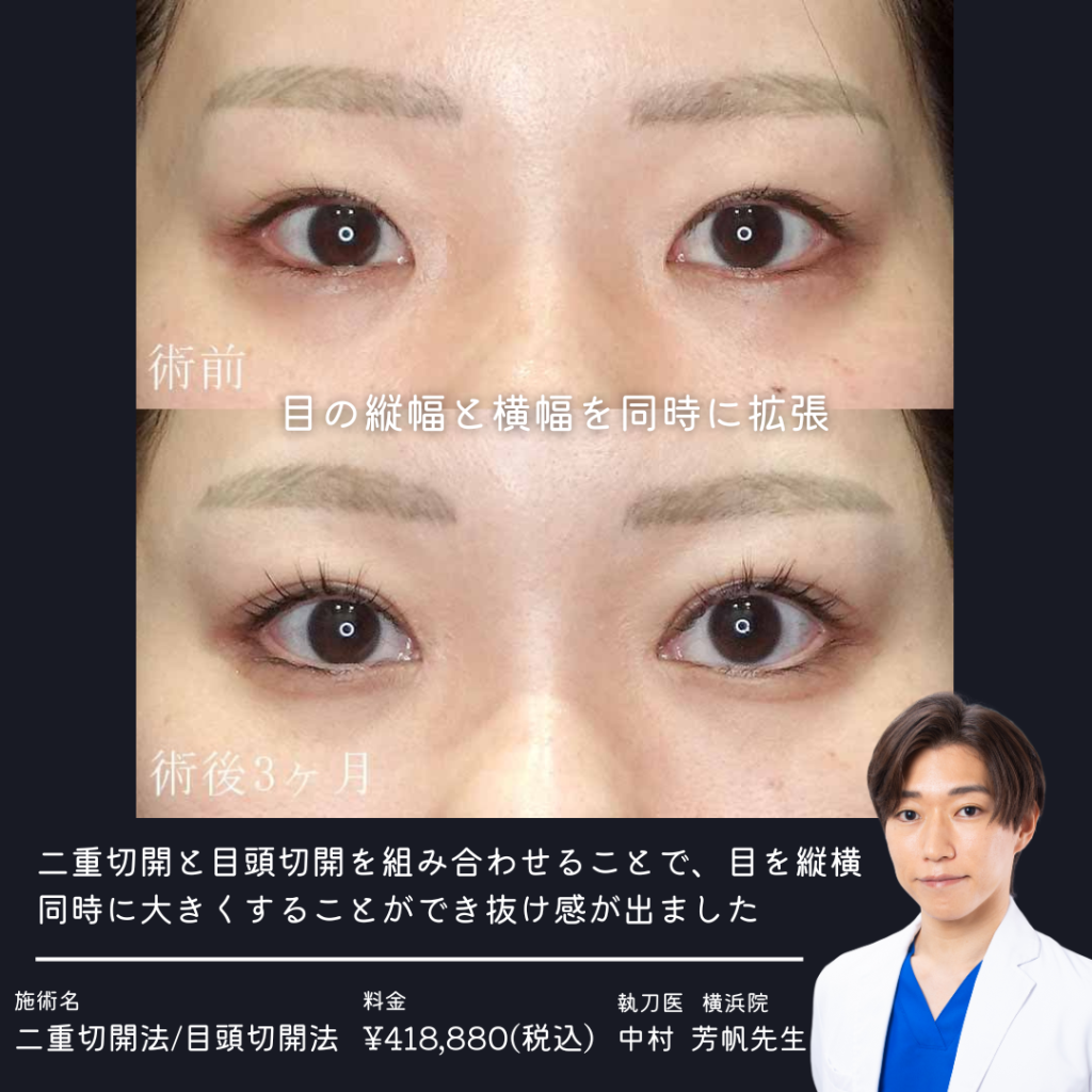 二重切開法+目頭切開の症例写真①