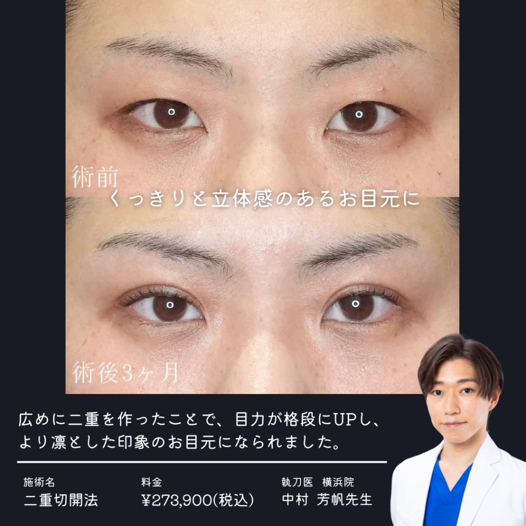 二重切開法の症例写真④