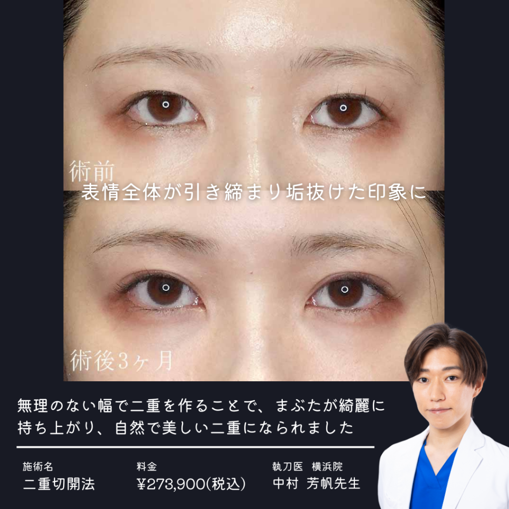 二重切開法の症例写真⑤