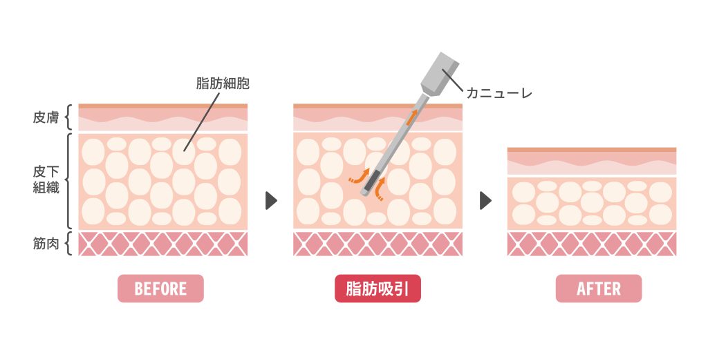 脂肪吸引イメージ