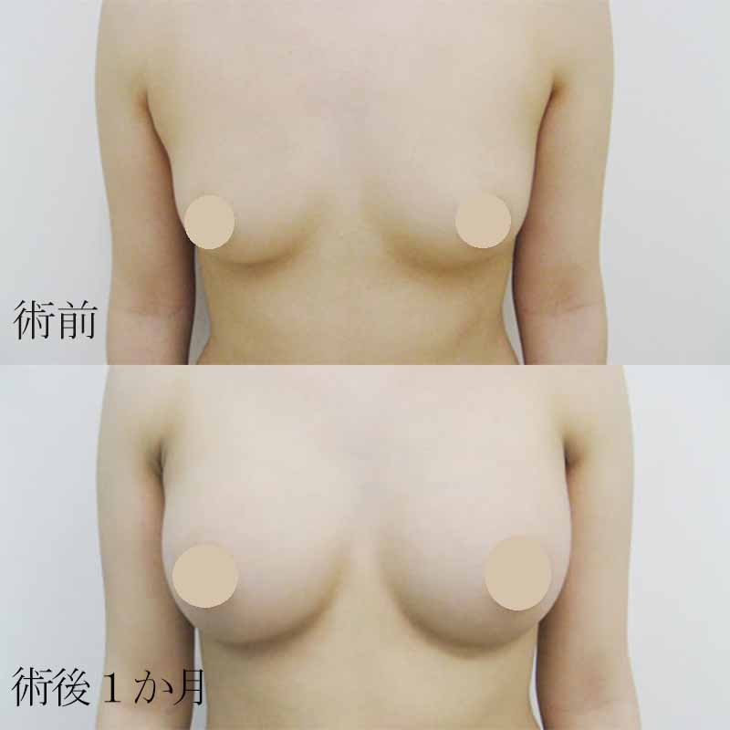 シリコンバッグ豊胸の症例写真