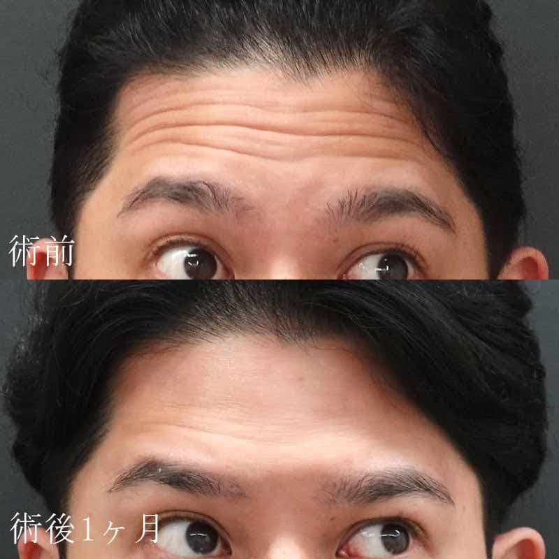 20241218_St20241218-4_ono_forehead_botox
