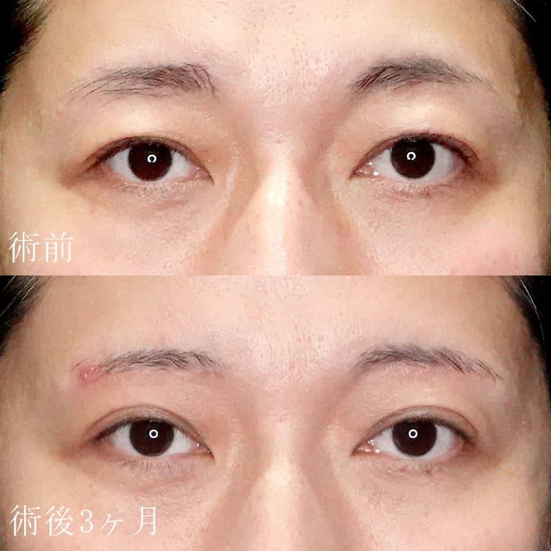 眉下切開症例写真