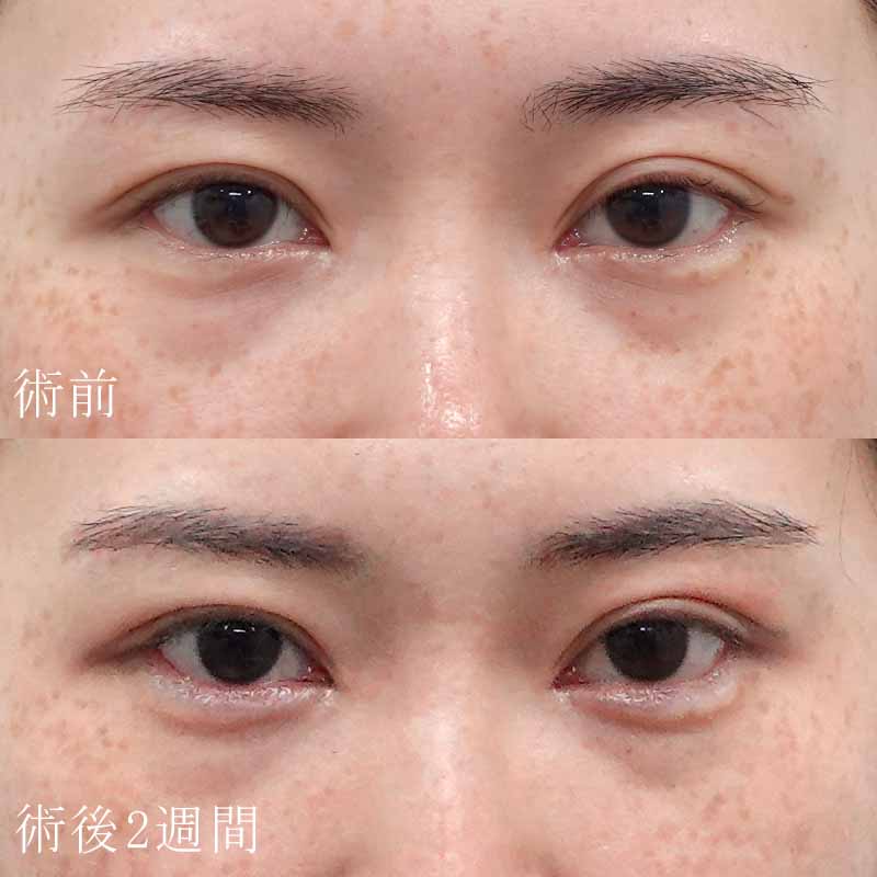 涙袋のヒアルロン酸注入症例写真②
