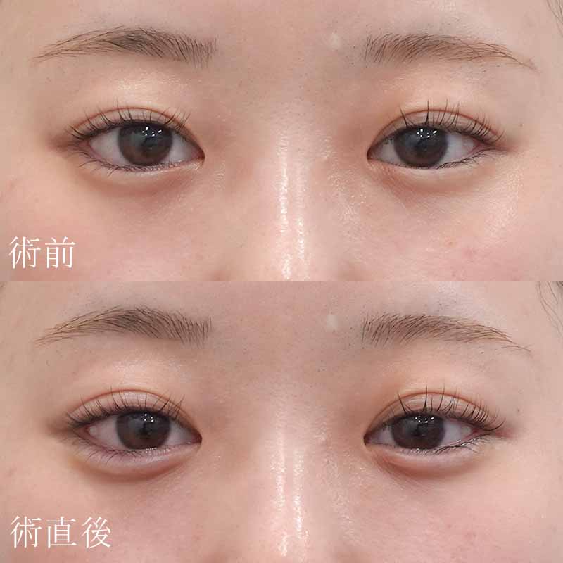 涙袋のヒアルロン酸注入症例写真①