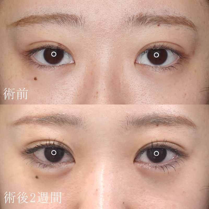 涙袋のヒアルロン酸注入症例写真③