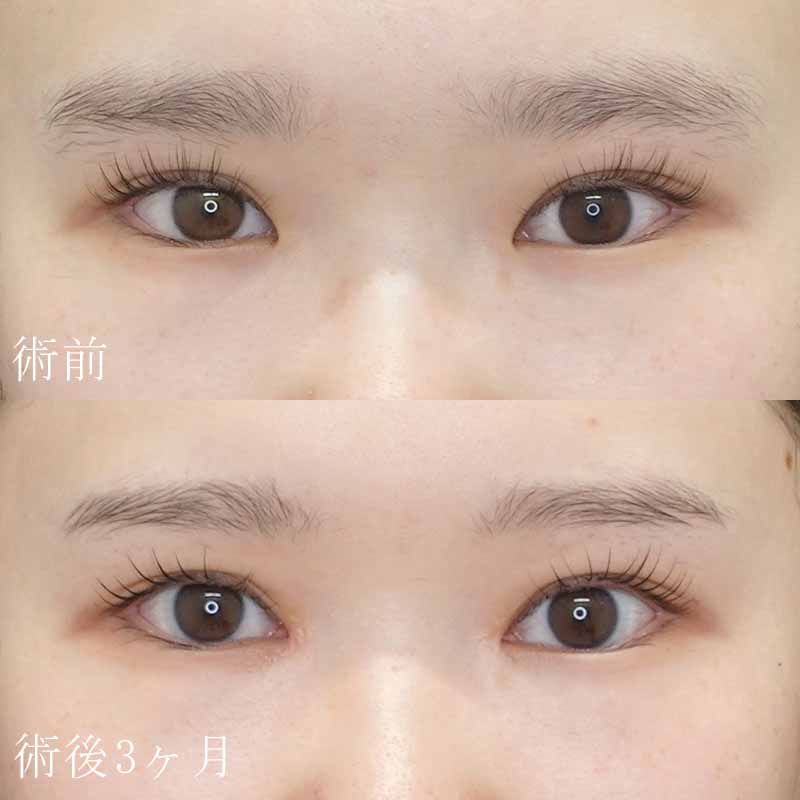 目頭切開（Z法）症例写真