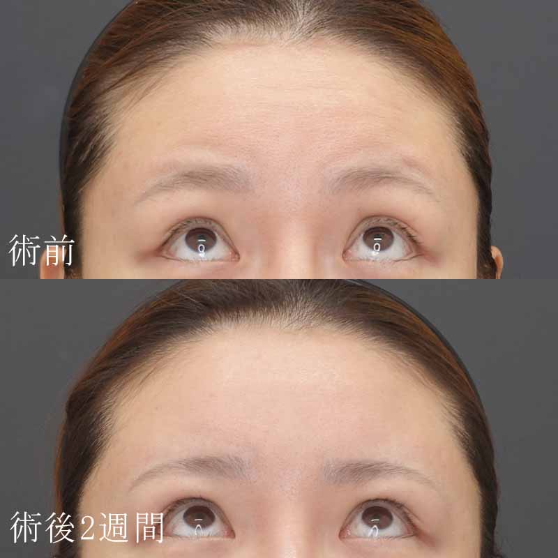 20250407_N4001_ono_forehead-botox01