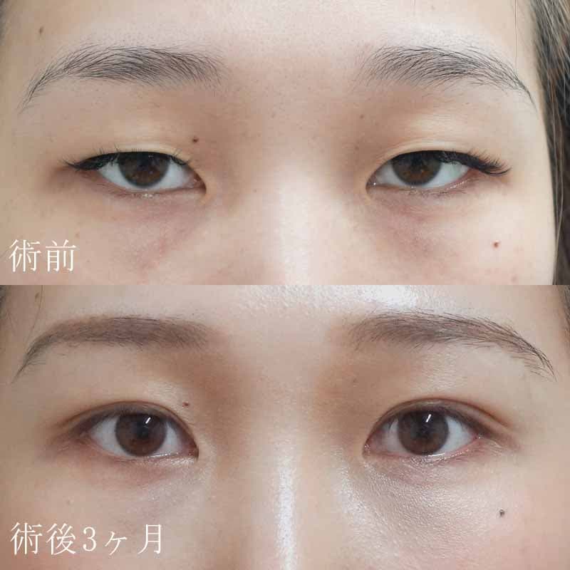 眼瞼下垂症例写真⓵