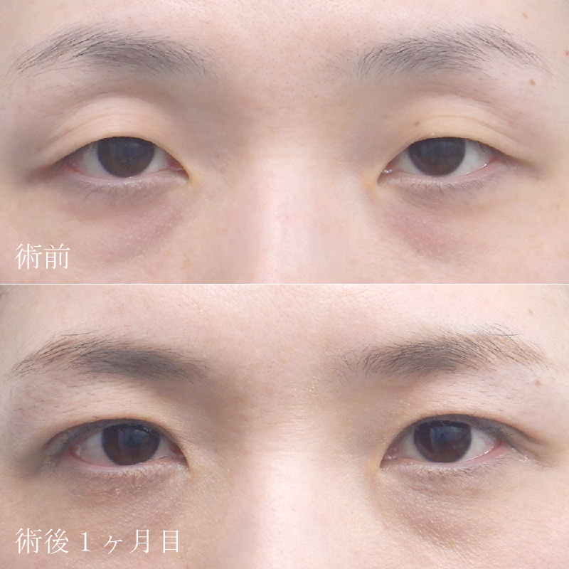 眼瞼下垂症例写真②