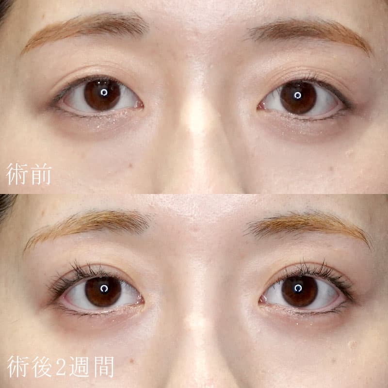 二重埋没法の症例写真①