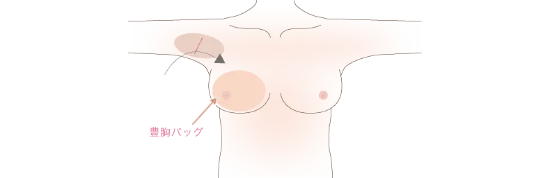 シリコンバック豊胸イメージイラスト
