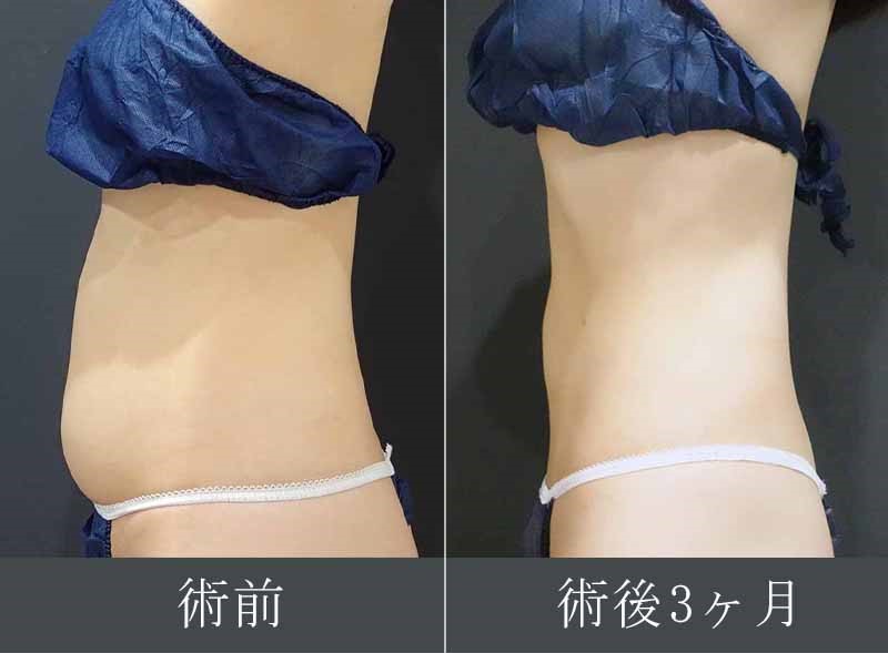 お腹の脂肪吸引症例写真②