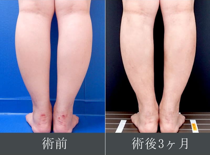 金子医師のふくらはぎの脂肪吸引症例写真
