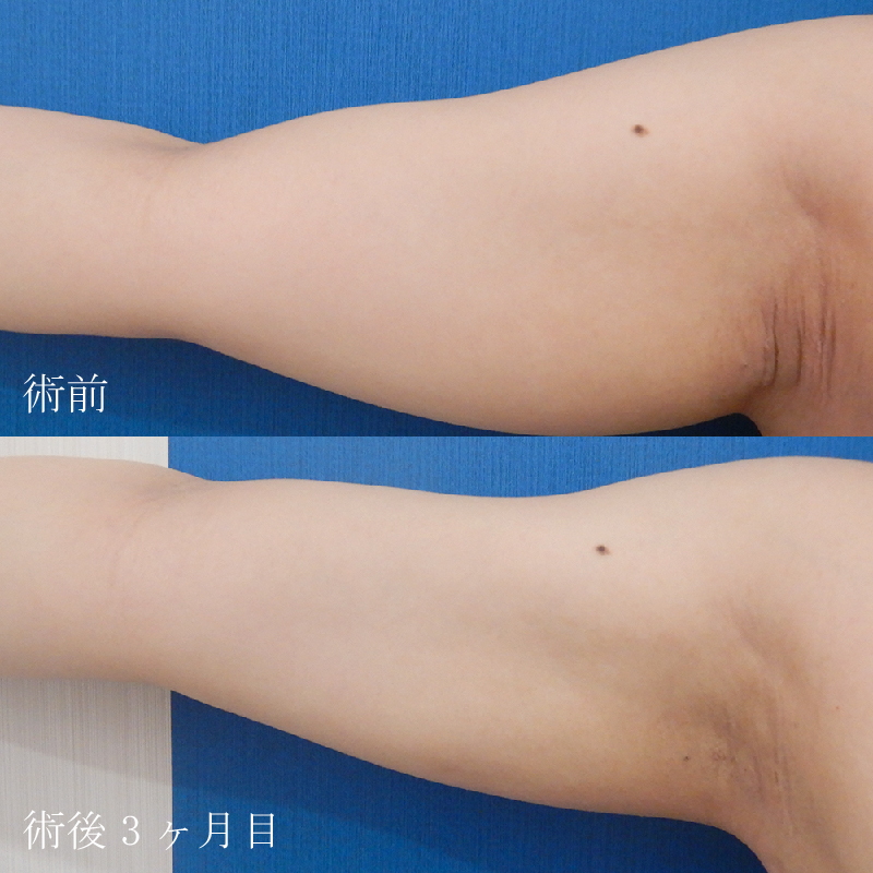 金子医師の二の腕の脂肪吸引症例写真②
