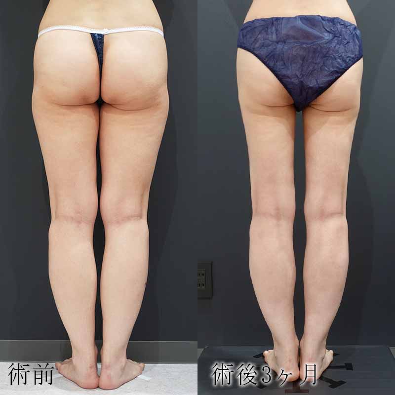 金子医師の太ももの脂肪吸引症例写真