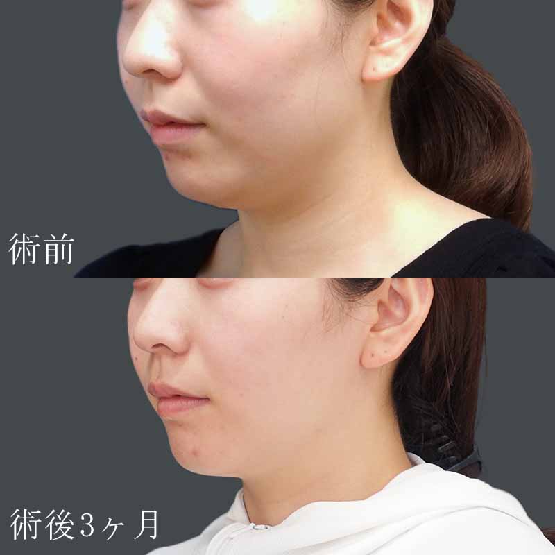 金子医師の顔の脂肪吸引症例写真