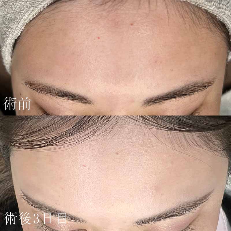 水の森美容クリニックのピコトーニング症例写真