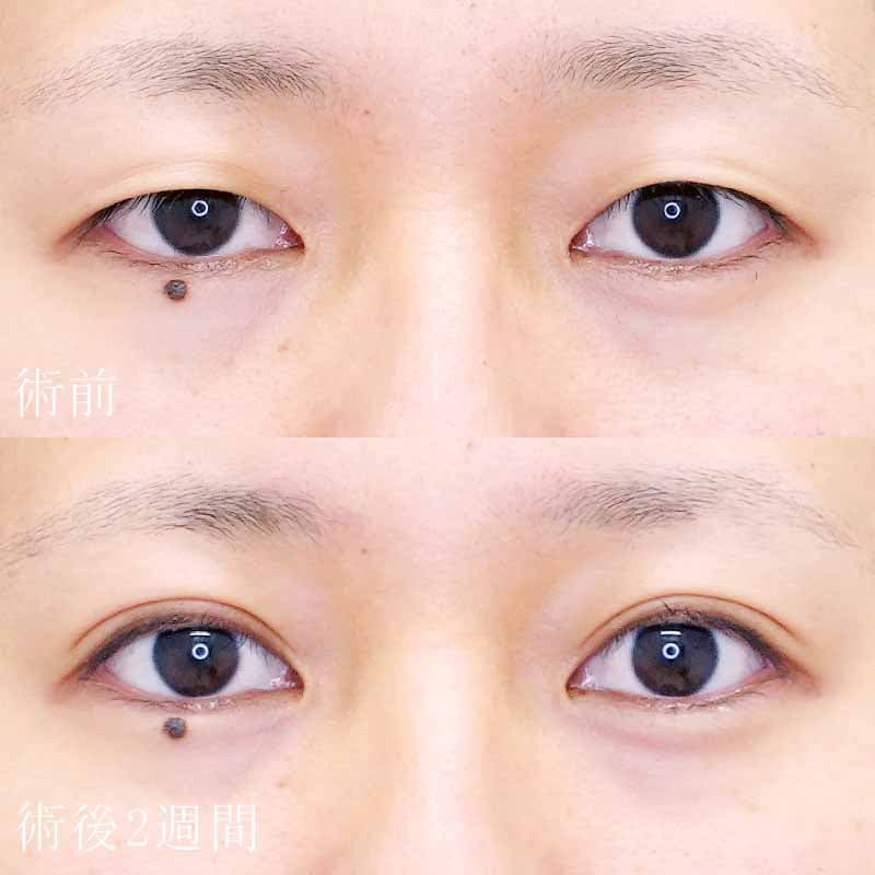 酒井医師の二重埋没法の症例写真①