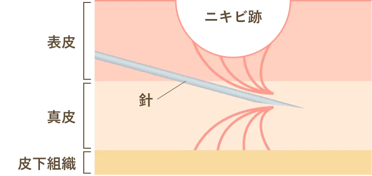 サブシジョン