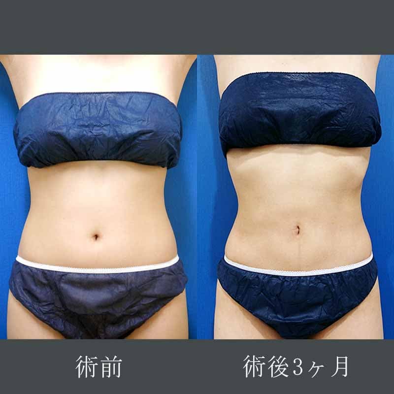 金子医師のお腹・ウエストの脂肪吸引症例写真①