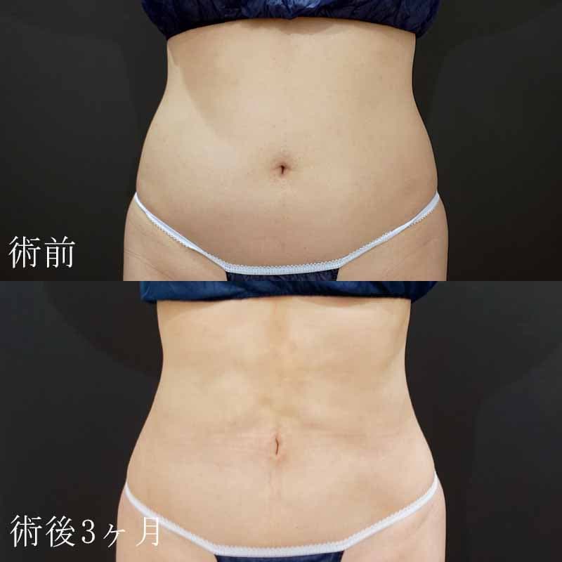 金子医師のお腹・ウエストの脂肪吸引症例写真②