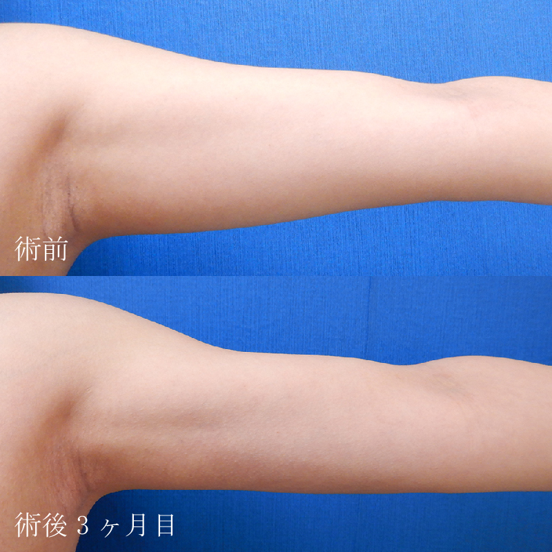 金子医師の二の腕の脂肪吸引症例写真①