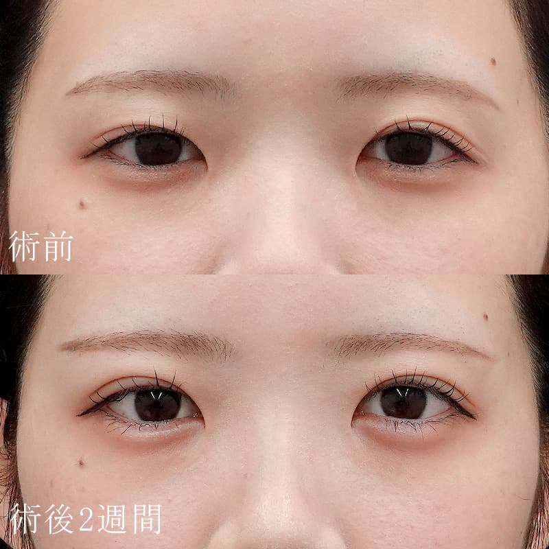 【太田医師】涙袋ヒアルロン酸＋二重埋没法