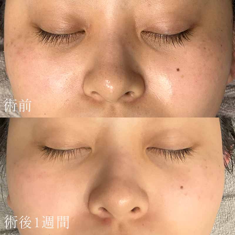 水の森美容クリニックのピーリング（PQAge）症例写真