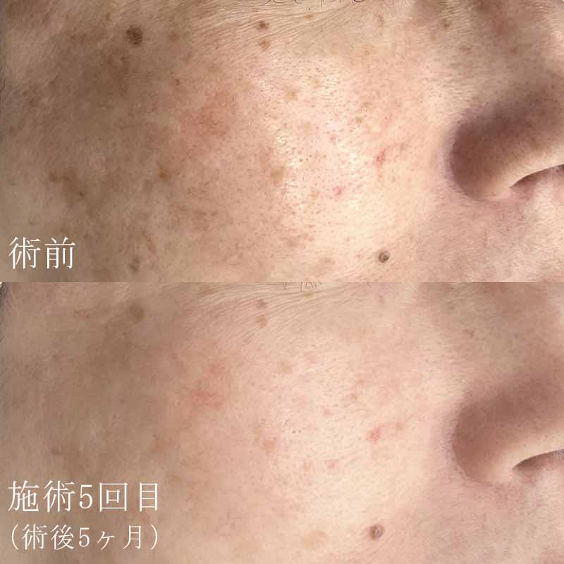 ピコトーニング症例写真①