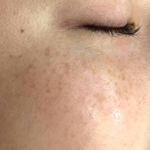 ピコスポット施術前