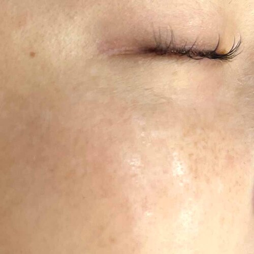 ピコスポット術後2週間