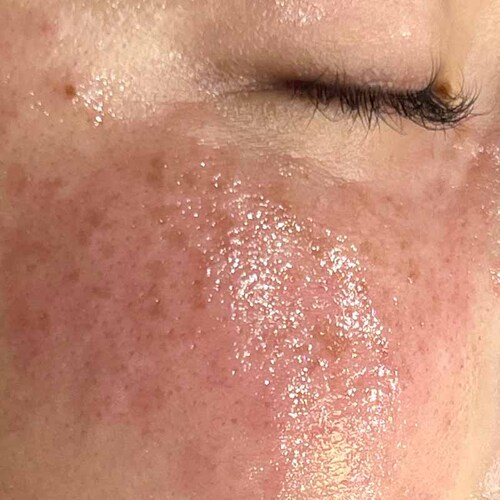 ピコスポット施術直後