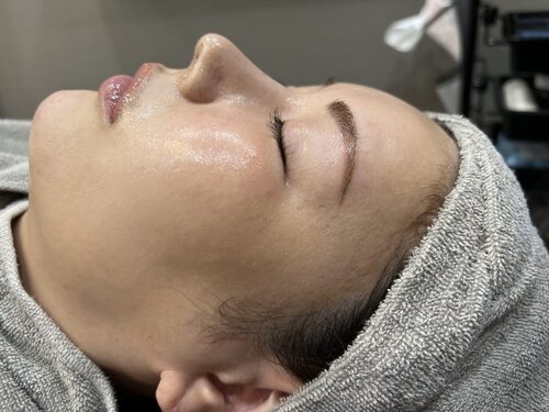 ピコフラクショナル施術前