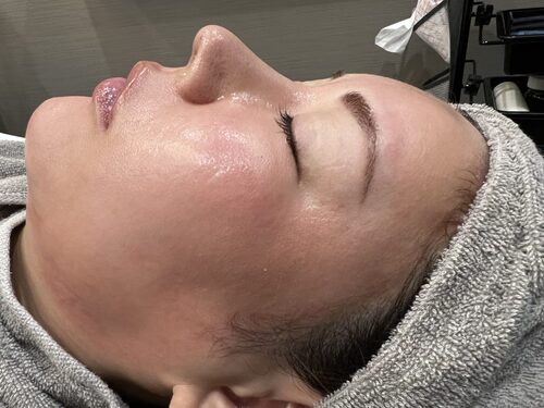 ピコフラクショナル施術直後