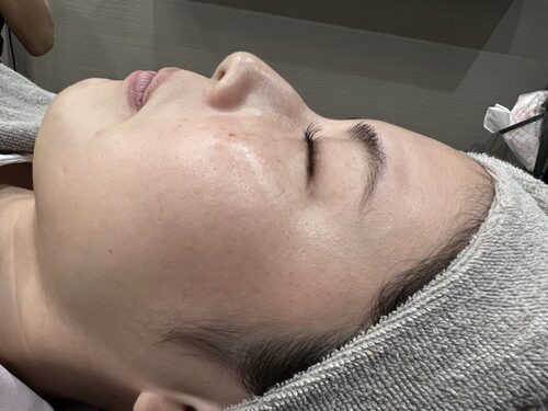 ピコトーニング施術前