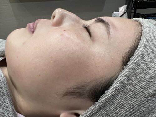 ピコトーニング施術直後