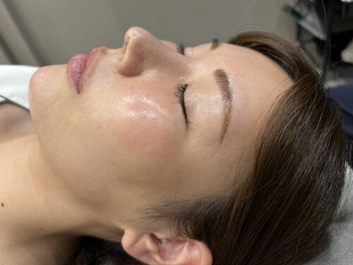 ピコフラクショナル施術4日後