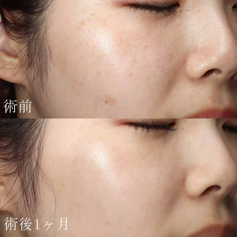 ピコスポット症例写真