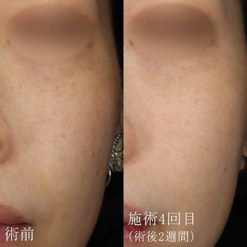 ピコフラクショナルの症例写真