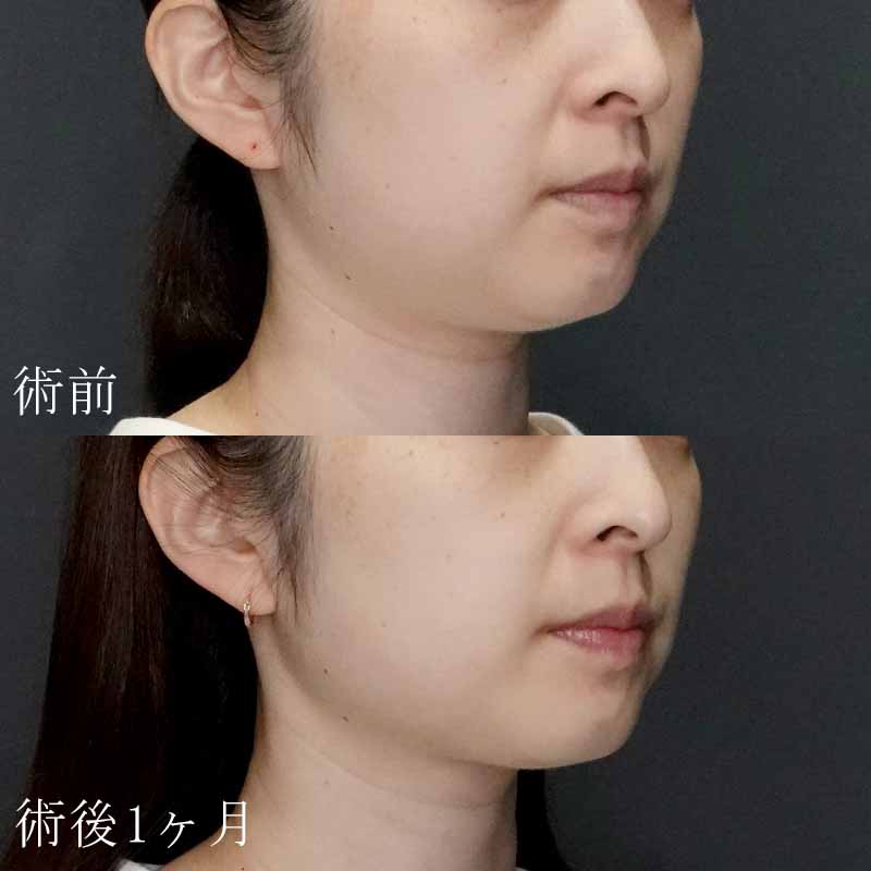 ボルフォーマーの症例写真