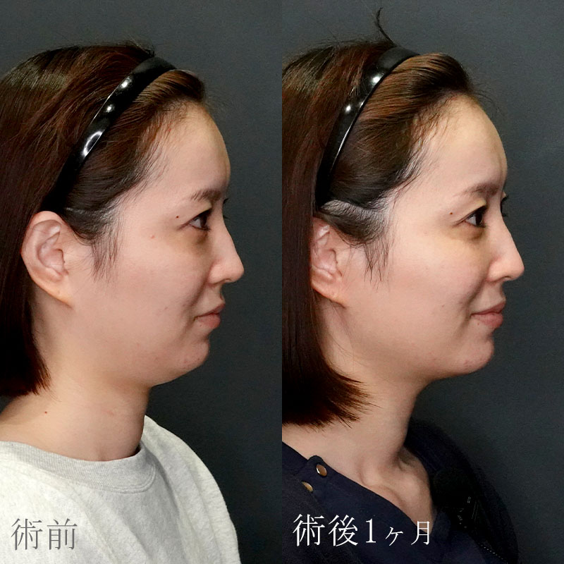 ボルニューマの症例写真