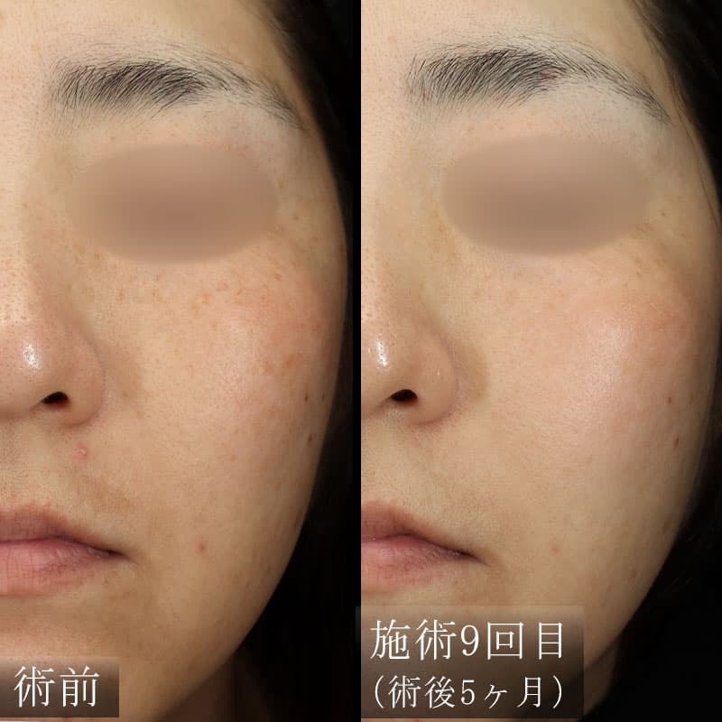 ピコトーニングの症例写真