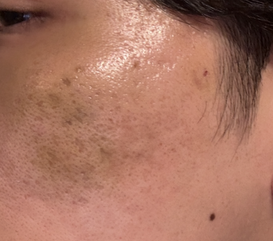 サブシジョンダウンタイム