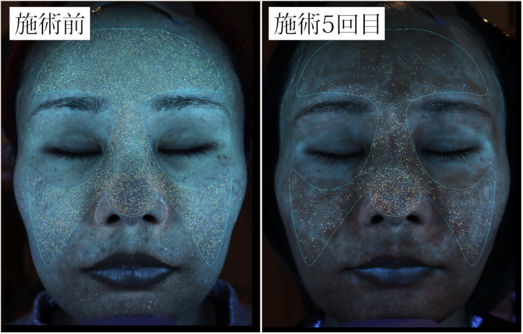 ダーマペン術前後のポルフィリン量の変化