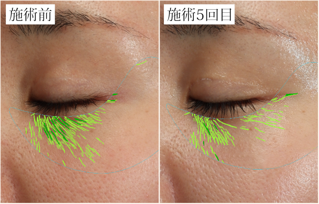 ダーマペン術前後の小じわの変化
