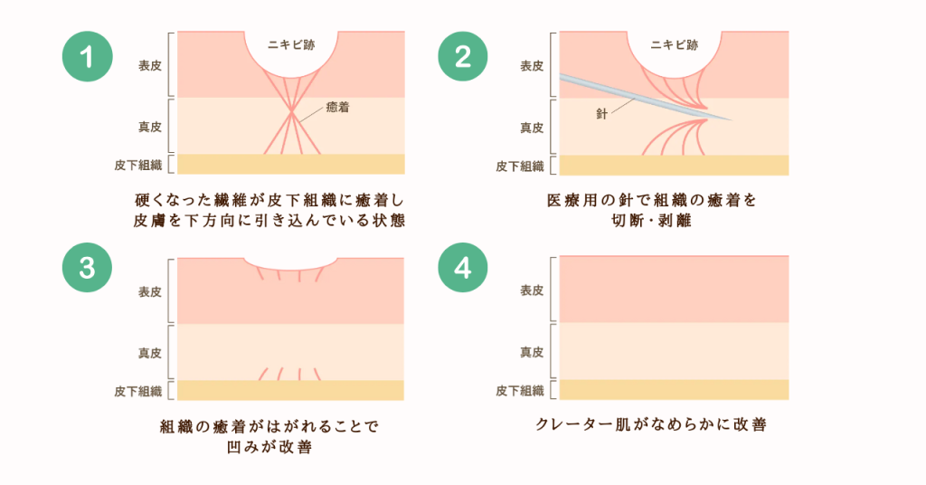 サブシジョンの治療法