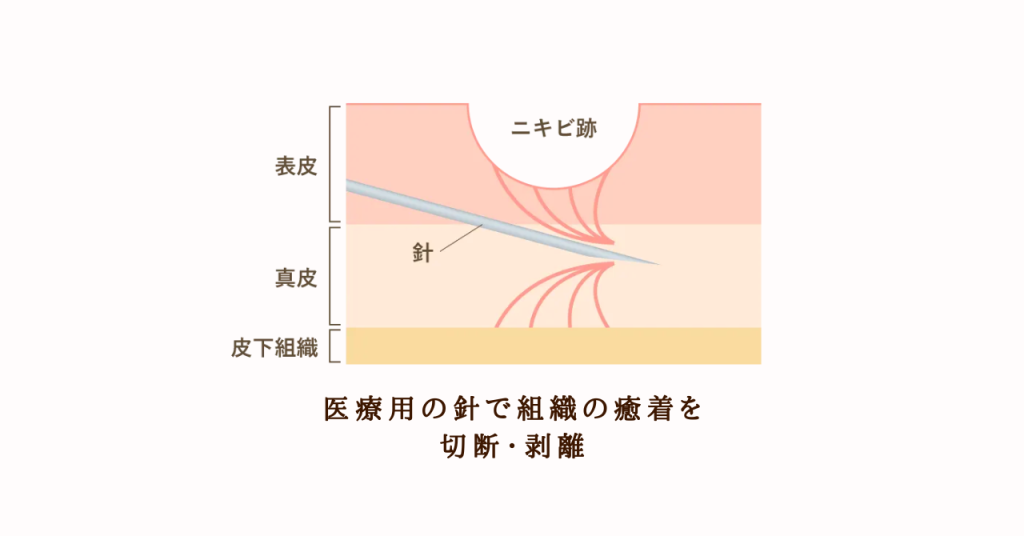 サブシジョンの治療法
